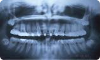 Orthodontie stomatophobe